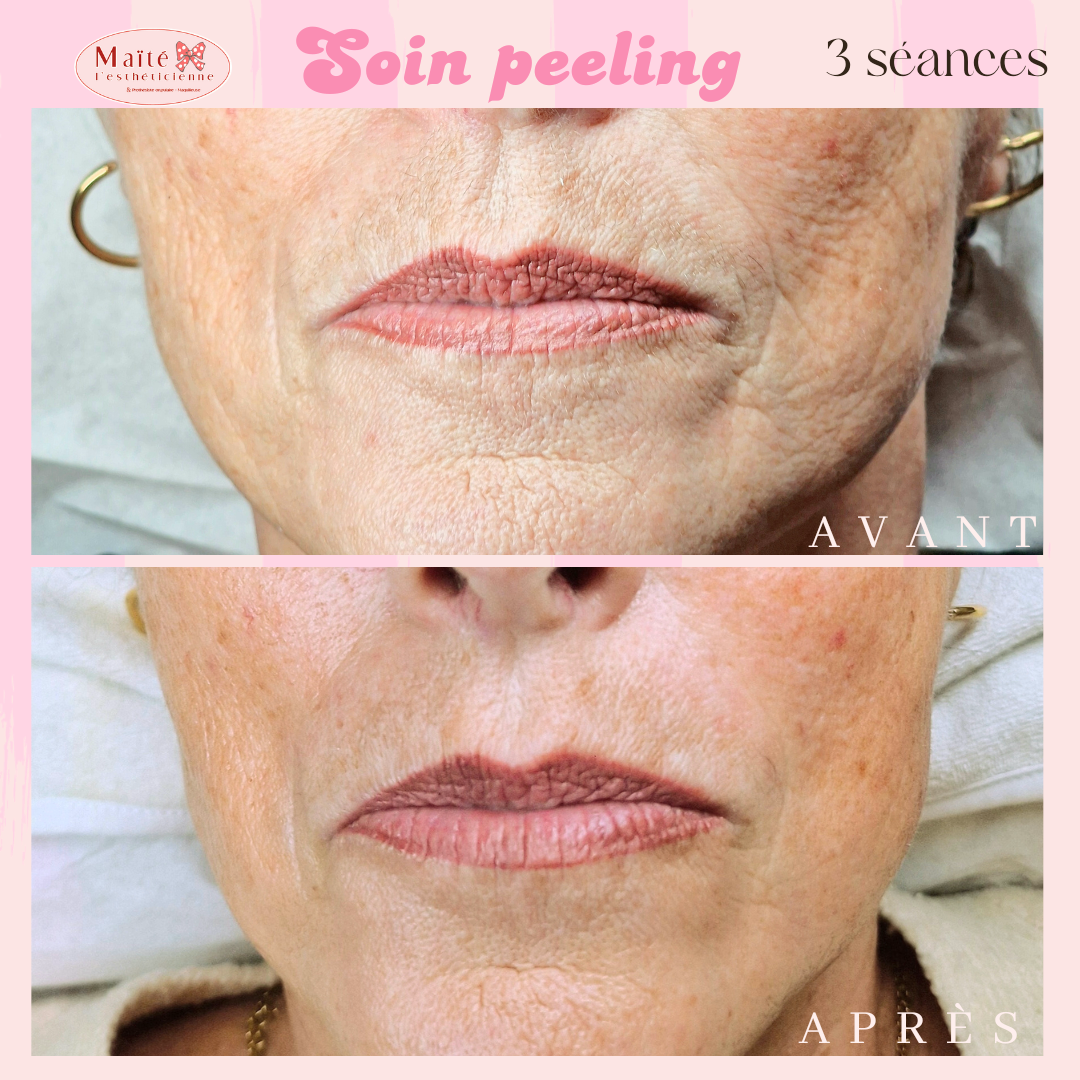 Soin peeling LCP professionnel