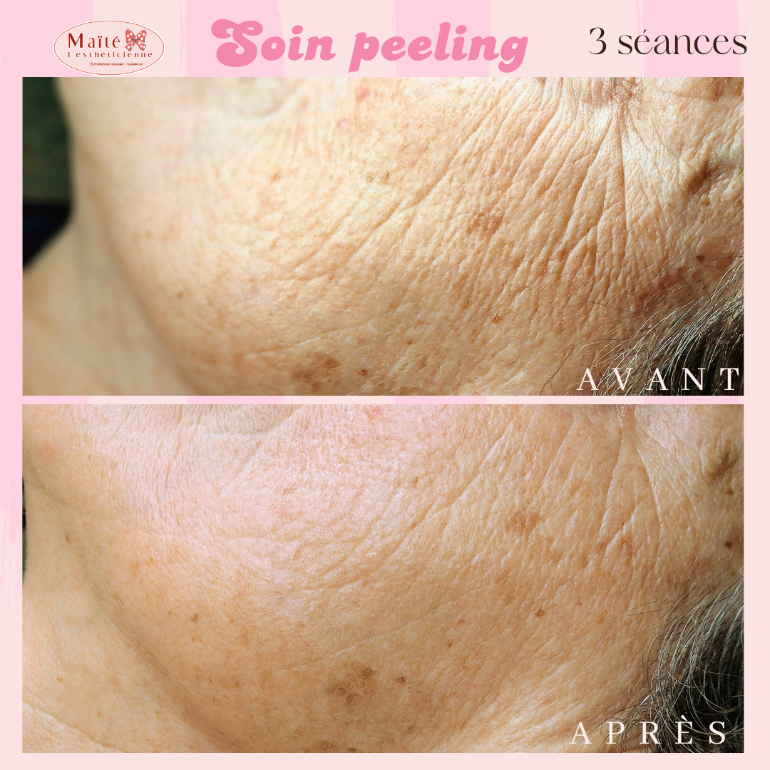 Soin peeling LCP professionnel