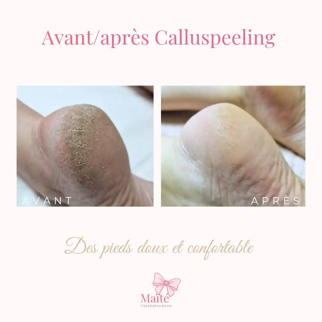 Calluspeeling résultat