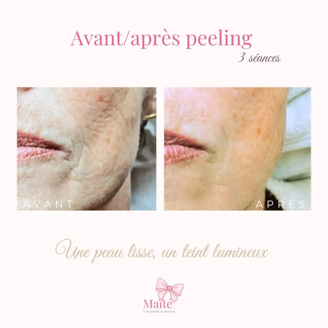 Peeling 3 séances